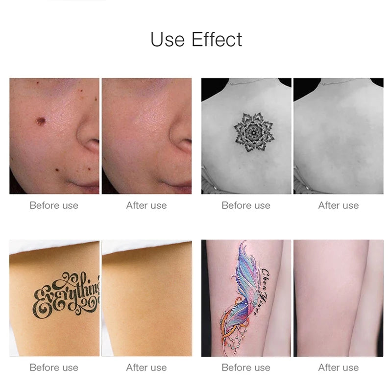 Pico Laser Skin Pen